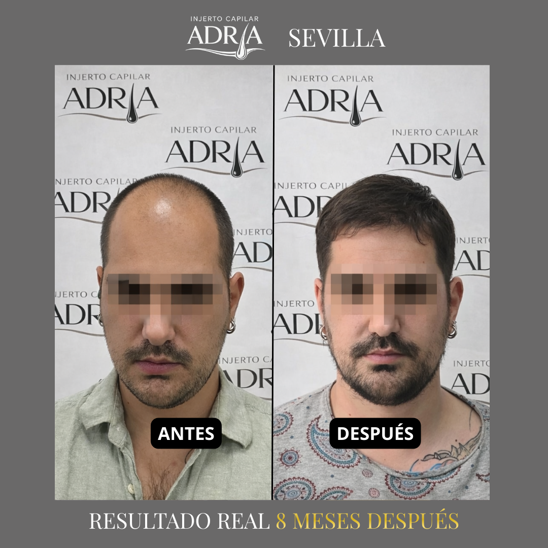 Injerto Capilar Adria Facebook ad