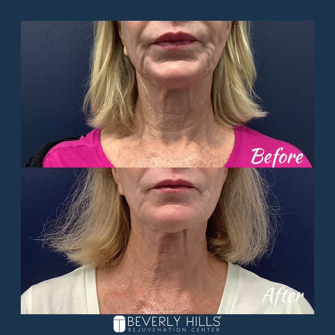 Beverly Hills Rejuvenation Center - Westlake Village & Valencia Facebook ad