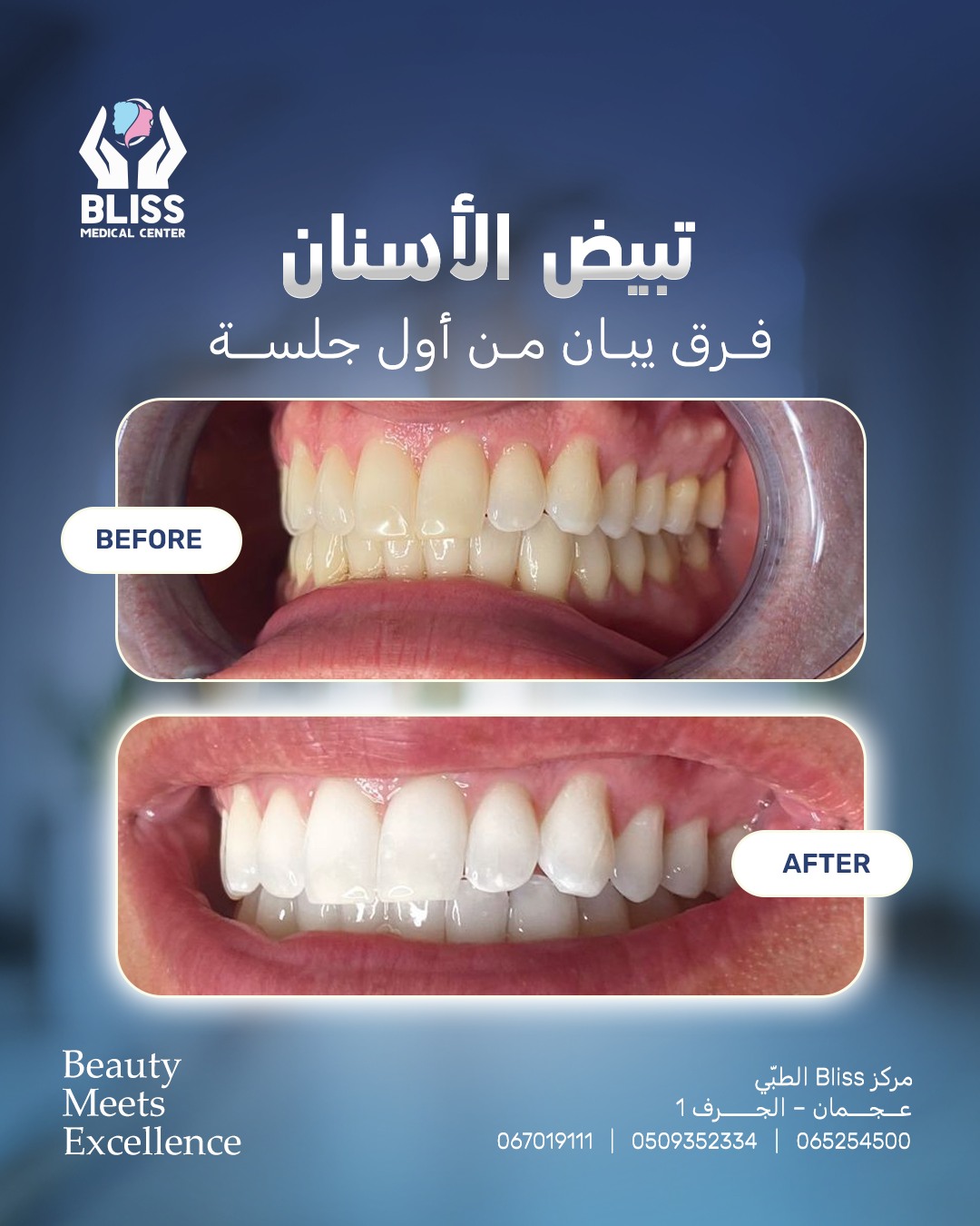 Bliss Medical Center مركز بليس الطبي Facebook ad: تبييض الأسنان… فرق يبان من أول جلسة