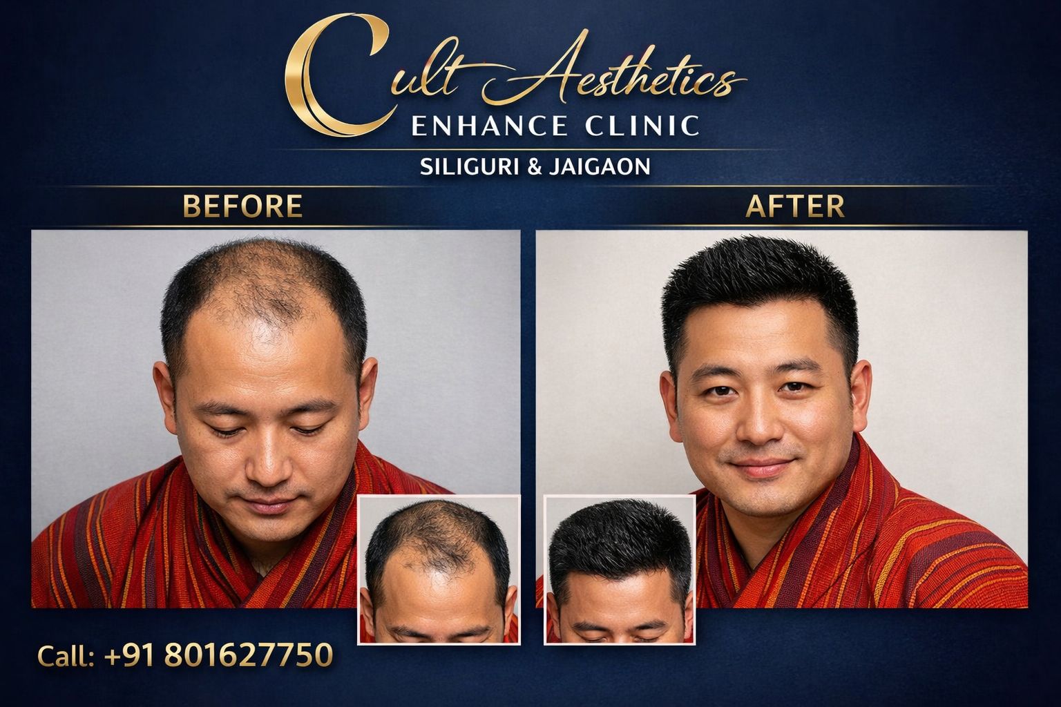 Cult Aesthetics enhance clinic Siliguri & Jaigaon Facebook ad: HAIR TRANSPLANT, BEARED TRANSPLANT, MOUSTACHE TRANSPLANT…