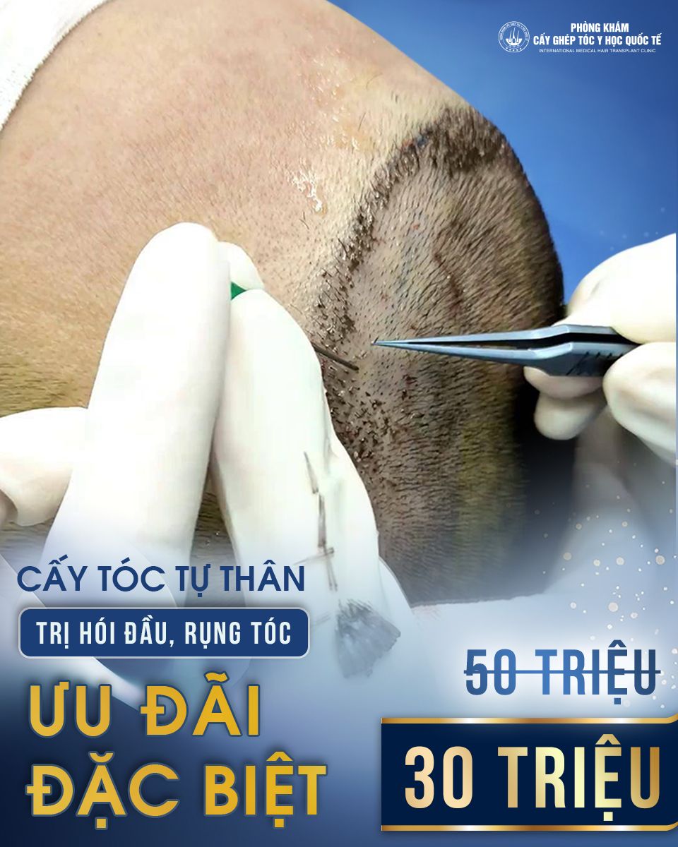 Cấy tóc Y học Quốc tế HN Hair Transplant Facebook ad