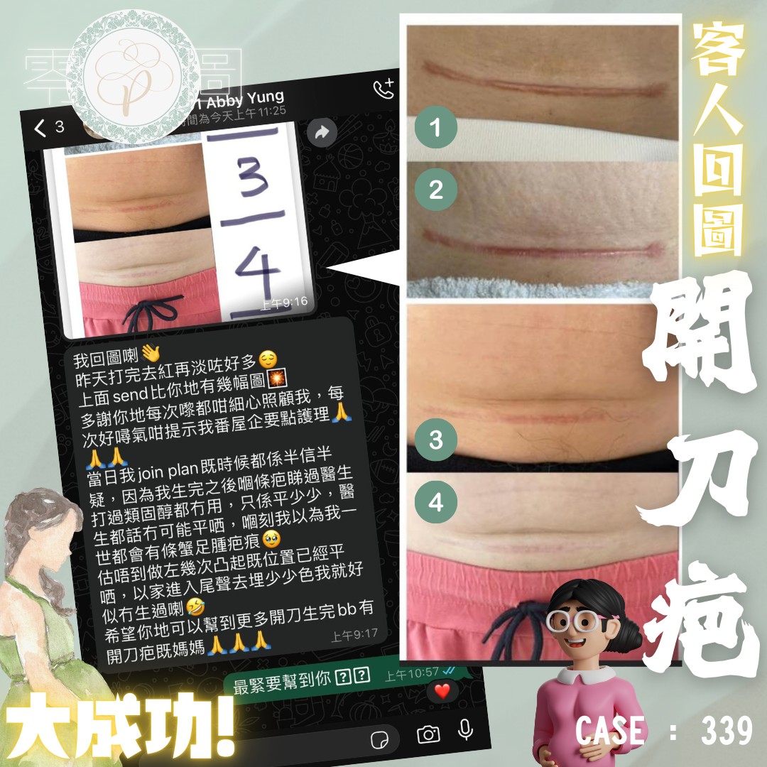 𝚒𝚝’𝚜 𝙷𝚎𝚊𝚕𝚒𝚗𝚐 疤痕修復專家 Facebook ad: 【客人回圖】【平痕時空肌】海量成功個案實証 「真」去疤神器 多種模式設定,專門針對各種不同疤痕類型,即時見效