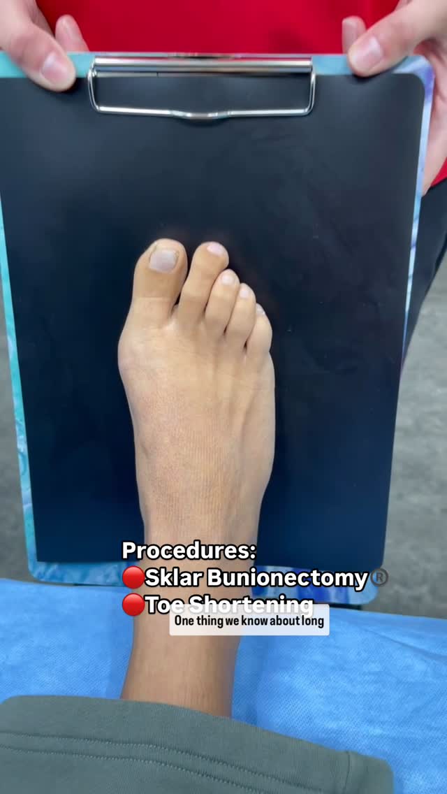 Foot First Podiatry Centers Facebook ad: Our Sklar Bunionectomy and toe shortening procedures offer…