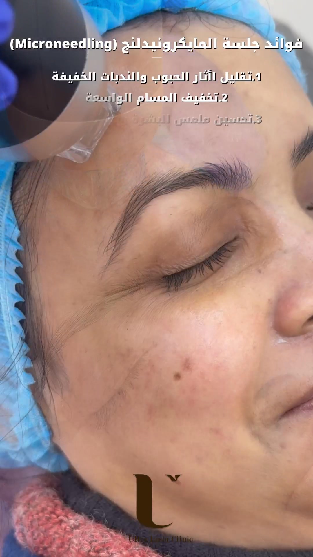 الترا ليزر كلينك Ultra Laser & Skin Care clinic Facebook ad: جلسة الـ 'مايكرونيدلنج