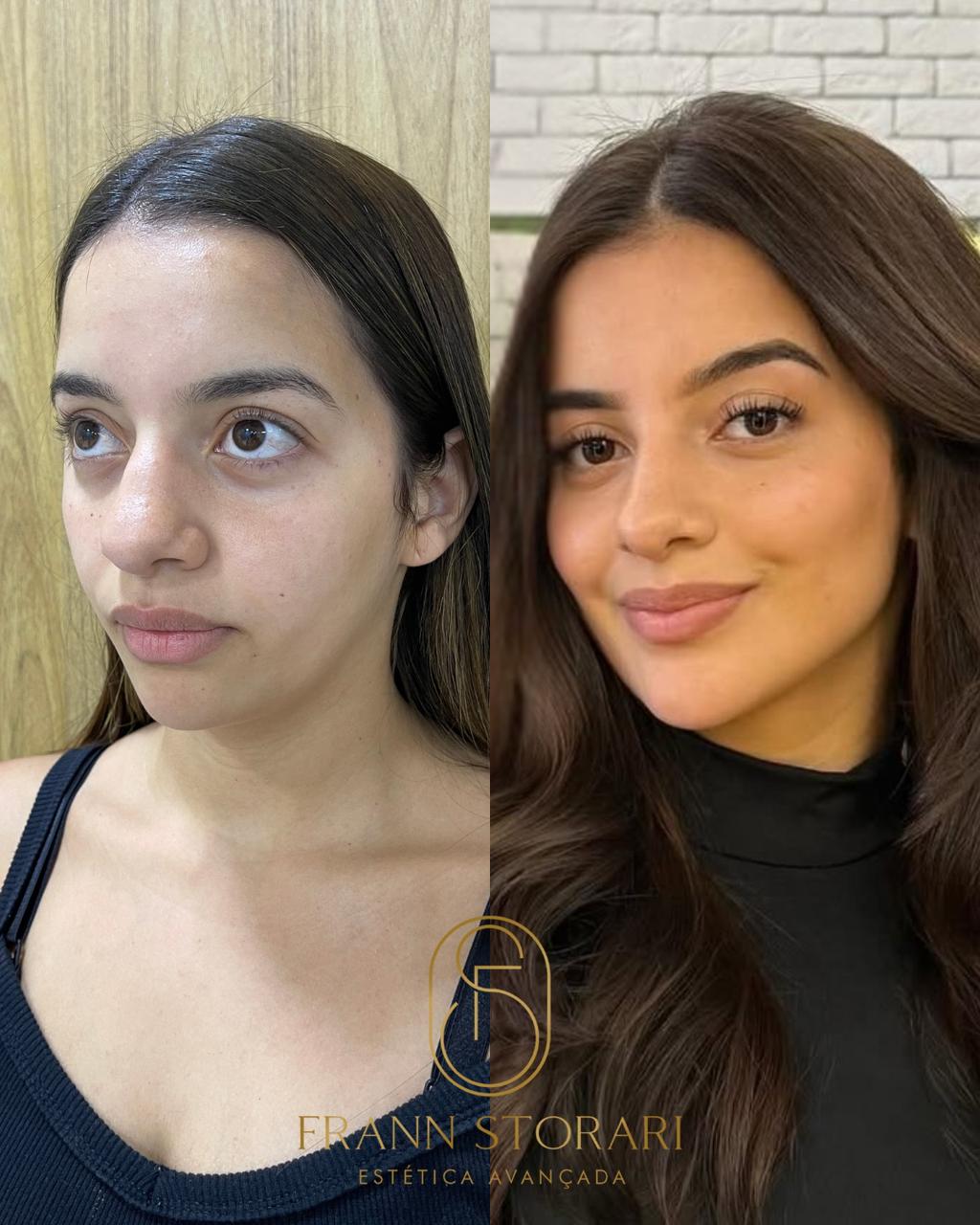 Dra. Frann Storari Facebook ad: Harmony Contour, Mais do que estética, é sobre…