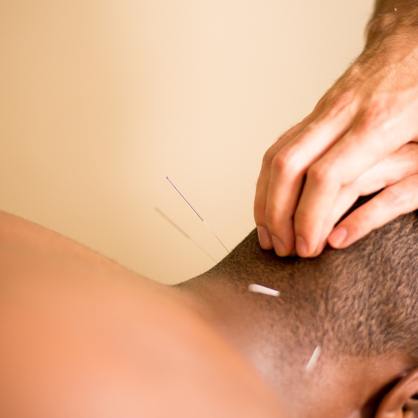 Messina Acupuncture PC Facebook ad: Struggling with back, shoulder, or TMJ pain?