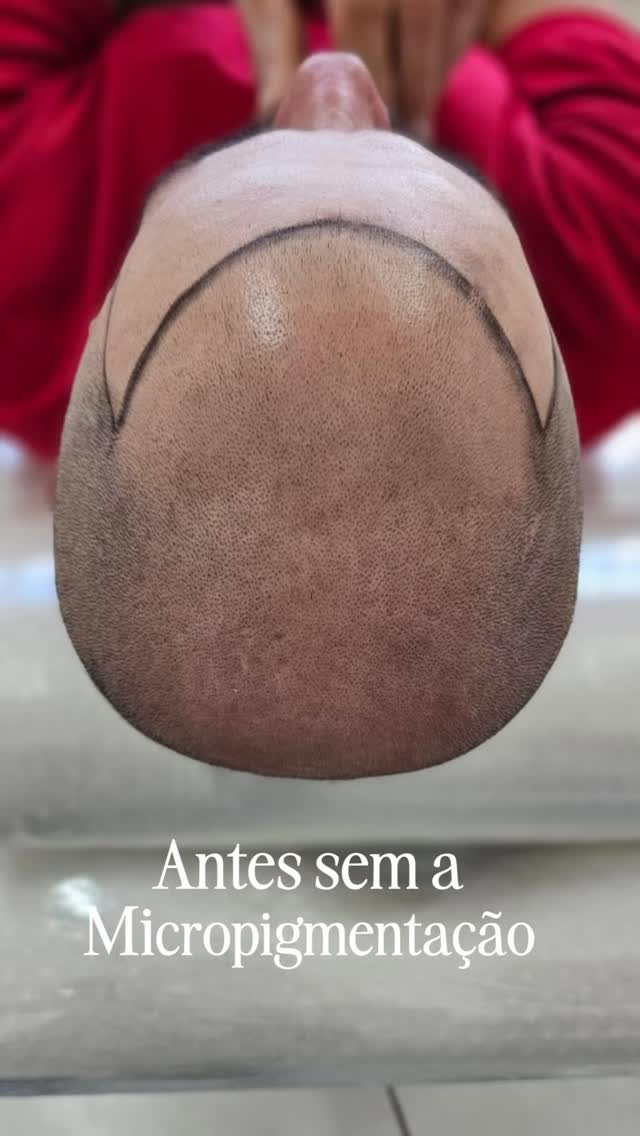 Skalp Micropigmentação DF Facebook ad: Antes da micropigmentação: falhas, insegurança e baixa…