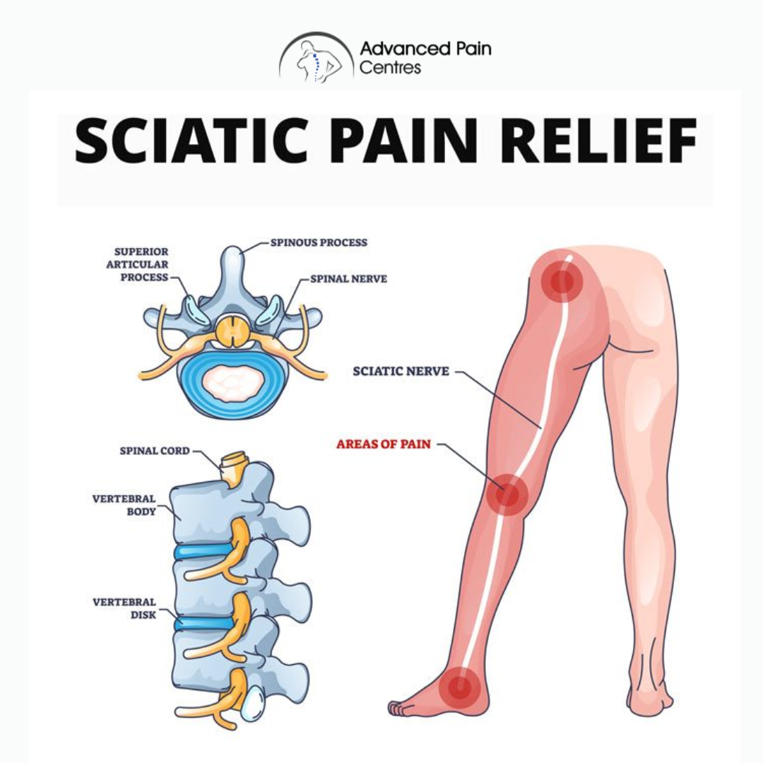 Advanced Pain Centres Facebook ad: Can’t Sit, Stand or Walk Without Leg Pain? Chat with us