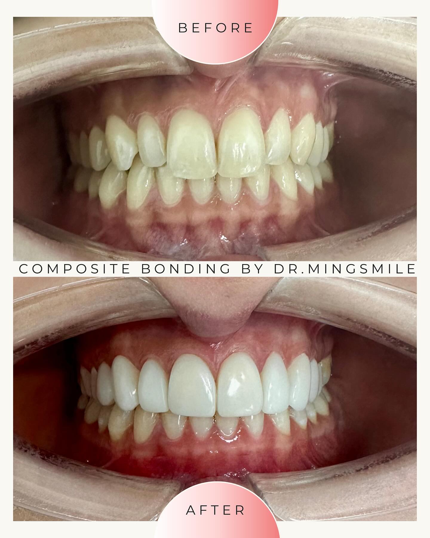 Dr.MingSmile คลีนิกทันตกรรมดร.หมิงสไมล์ จัดฟัน ทำฟัน คลองท่อม คลองพน กระบี่ Facebook ad: This lovely patient came with naturally small side…