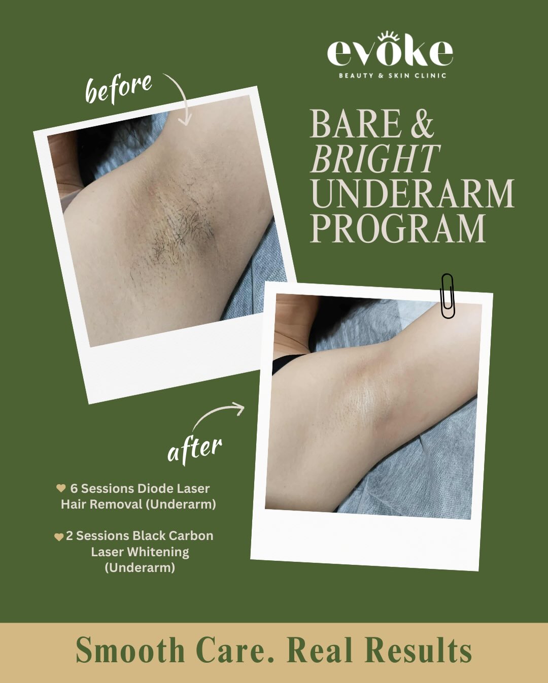 Evoke Beauty & Skin Clinic Facebook ad: You deserve to raise your arms without thinking…