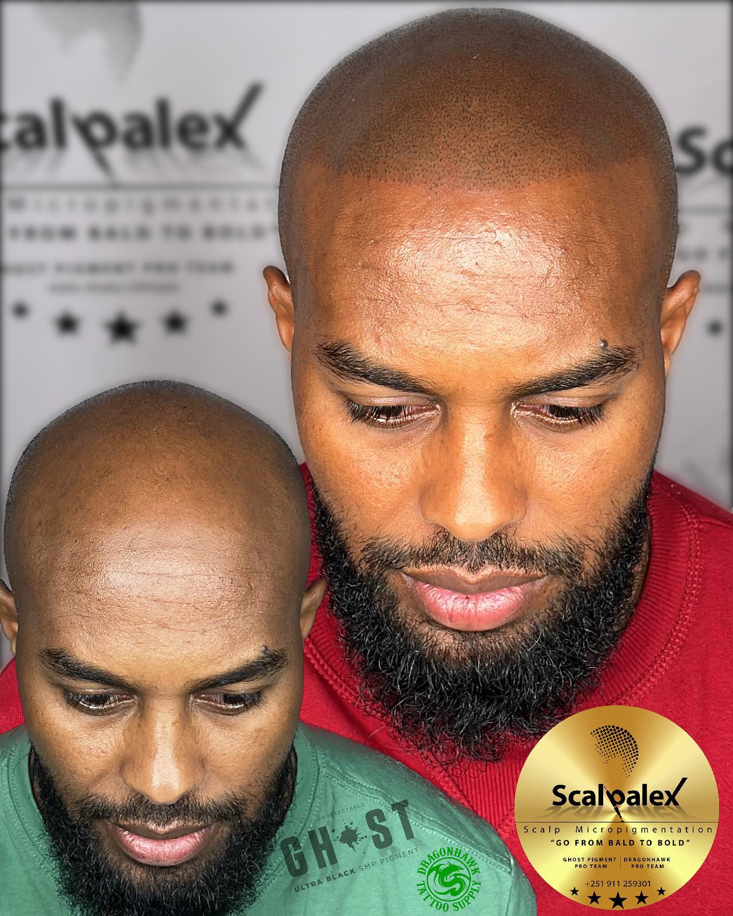 Scalpalex Scalp Micropigmentation Facebook ad: የረቀቀ የፀጉር ታቱ(SMP)