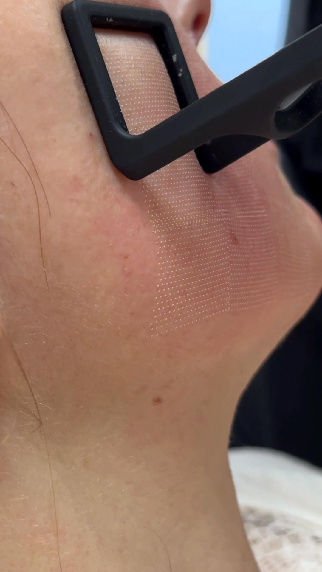 REVÙ CLINIC Facebook ad: Giluminis odos struktūros atkūrimas su frakciniu DEKA…