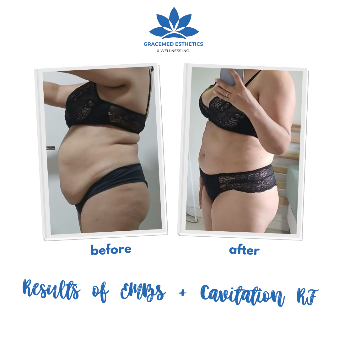GraceMed Esthetics & Wellness Inc. Facebook ad: 1 EMBS + 1 Cavitation RF + Consultation Now $249!