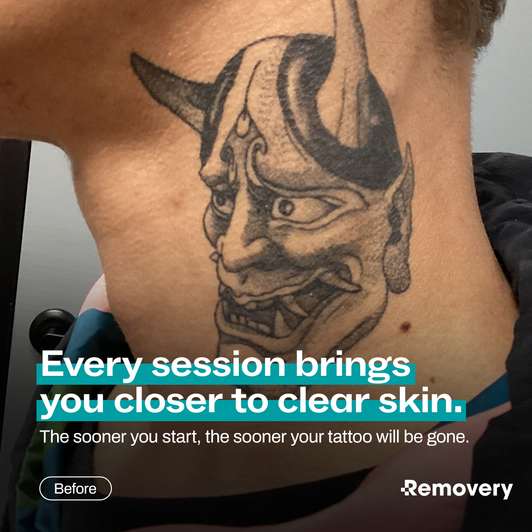 Removery Facebook ad: Laser tattoo removal helps you let go of…