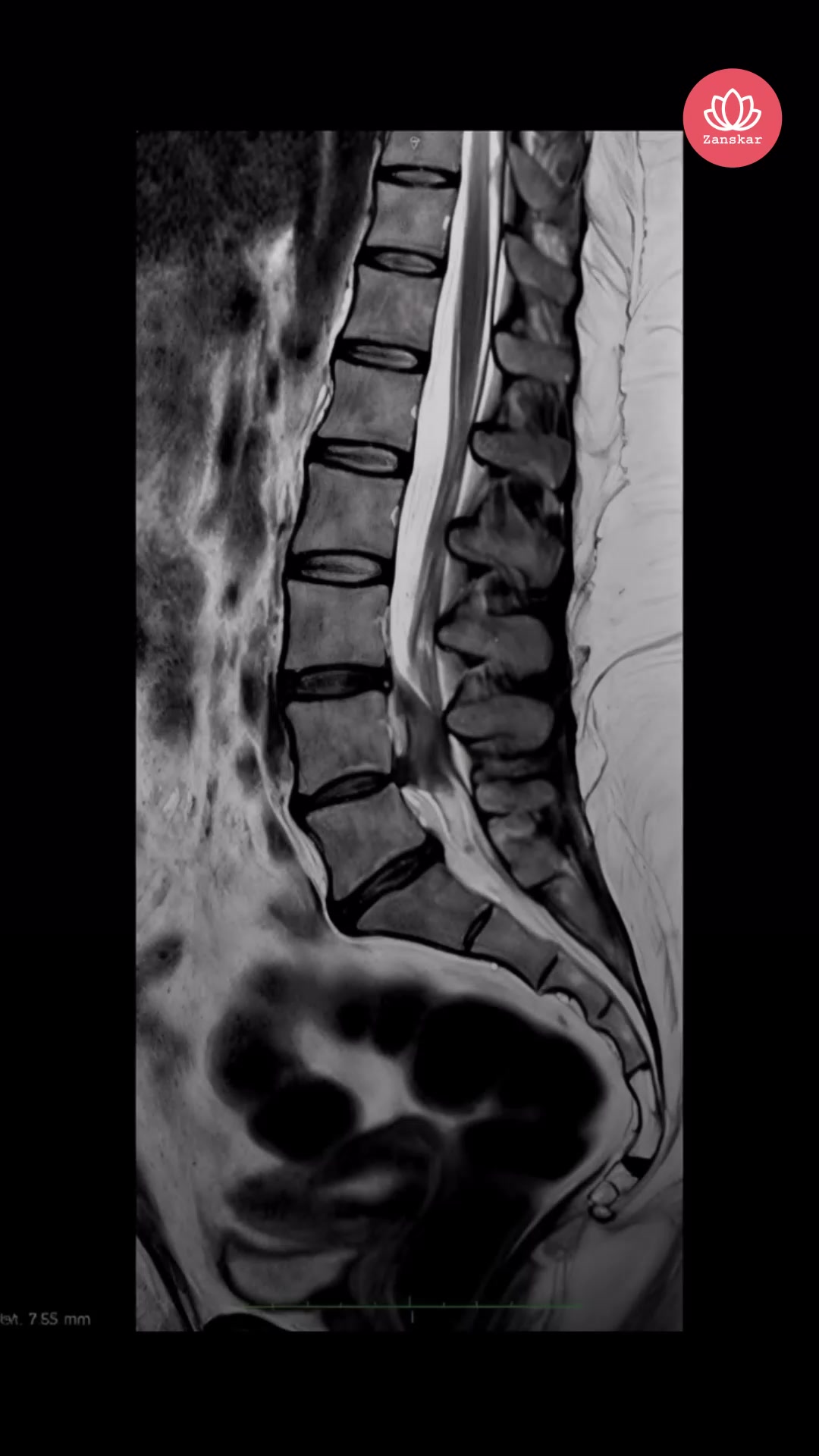 Zanskar: Muscle & Joint Relief Facebook ad: 30-Day Support For Back Pain*