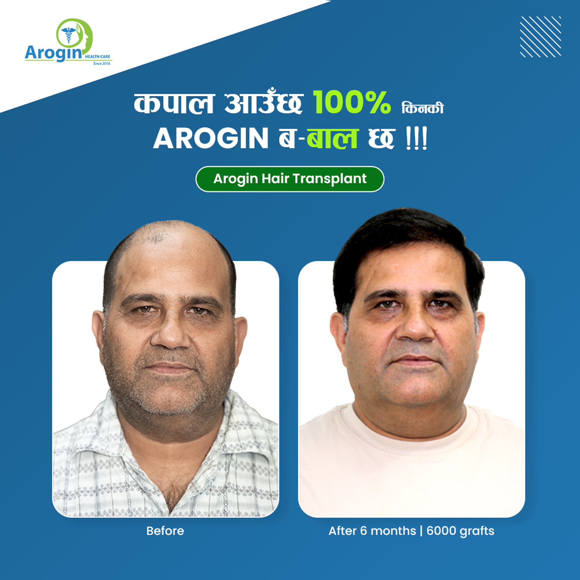 Arogin Healthcare - Hair Transplant Center Nepal Facebook ad