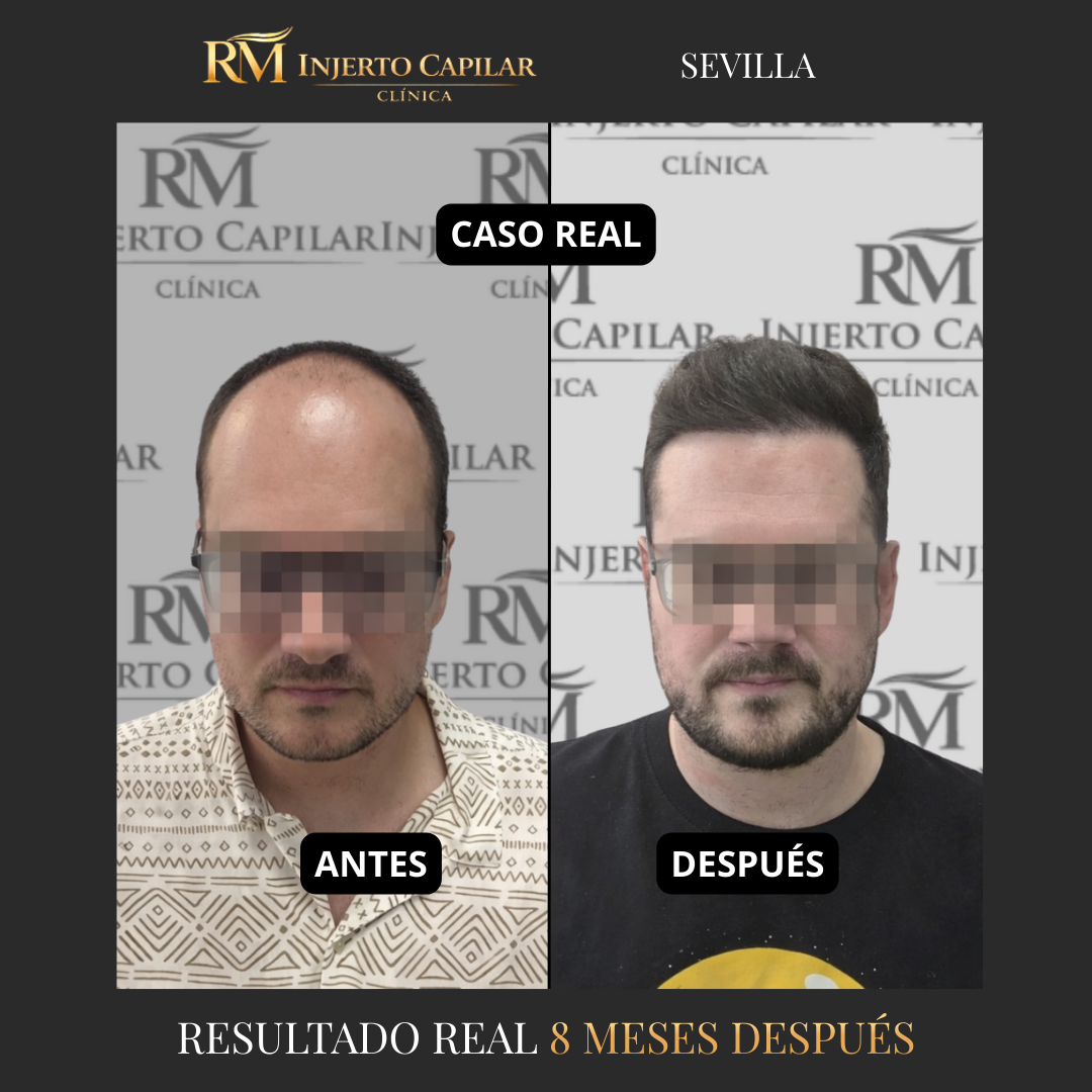 RM Injerto Capilar Facebook ad: Resultados reales de injerto capilar