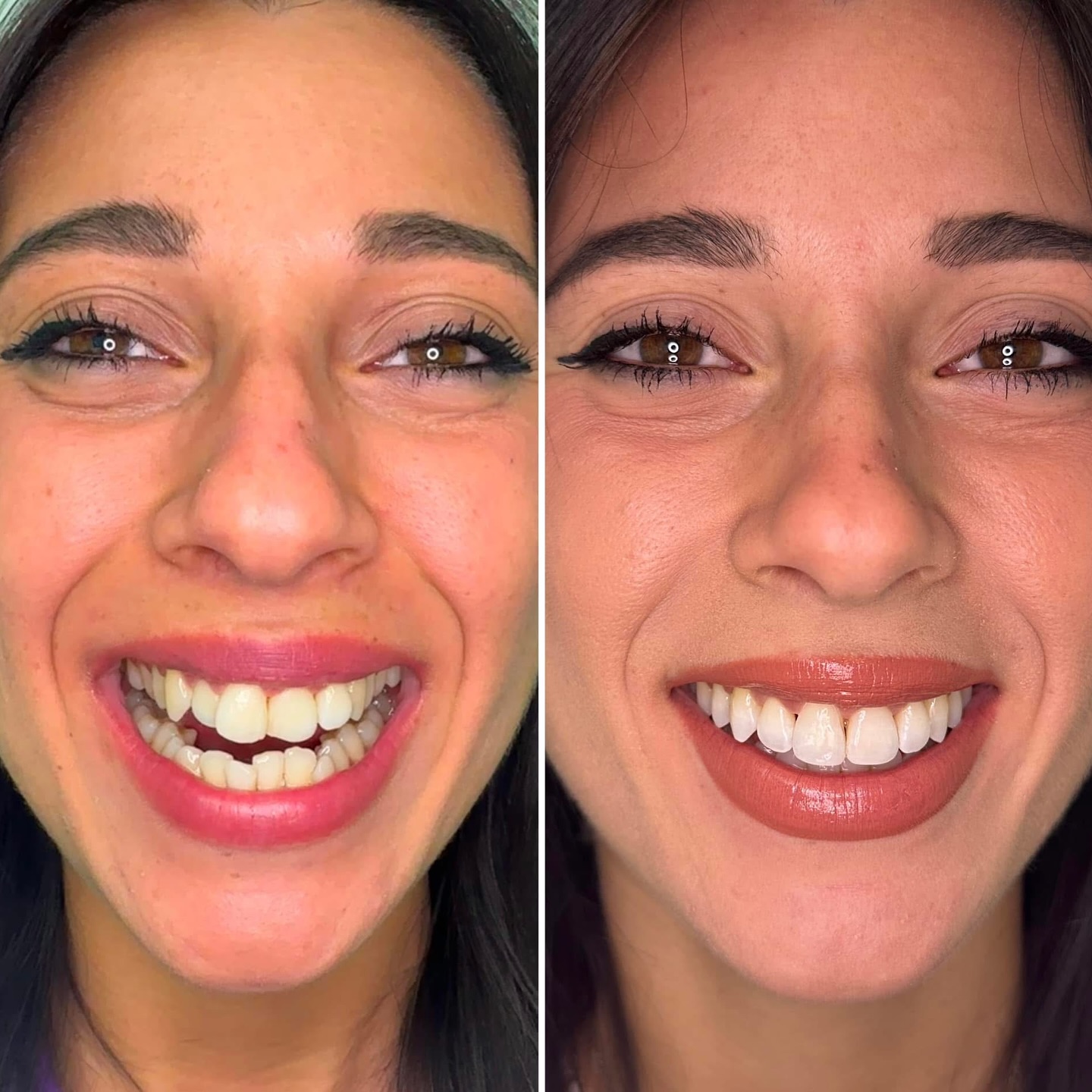 Dentista a Bari - Studio Dr.ssa Antonella Scorca Facebook ad: SOLO 7 MESI CON IL NOSTRO APPARECCHIO INVISIBILE…