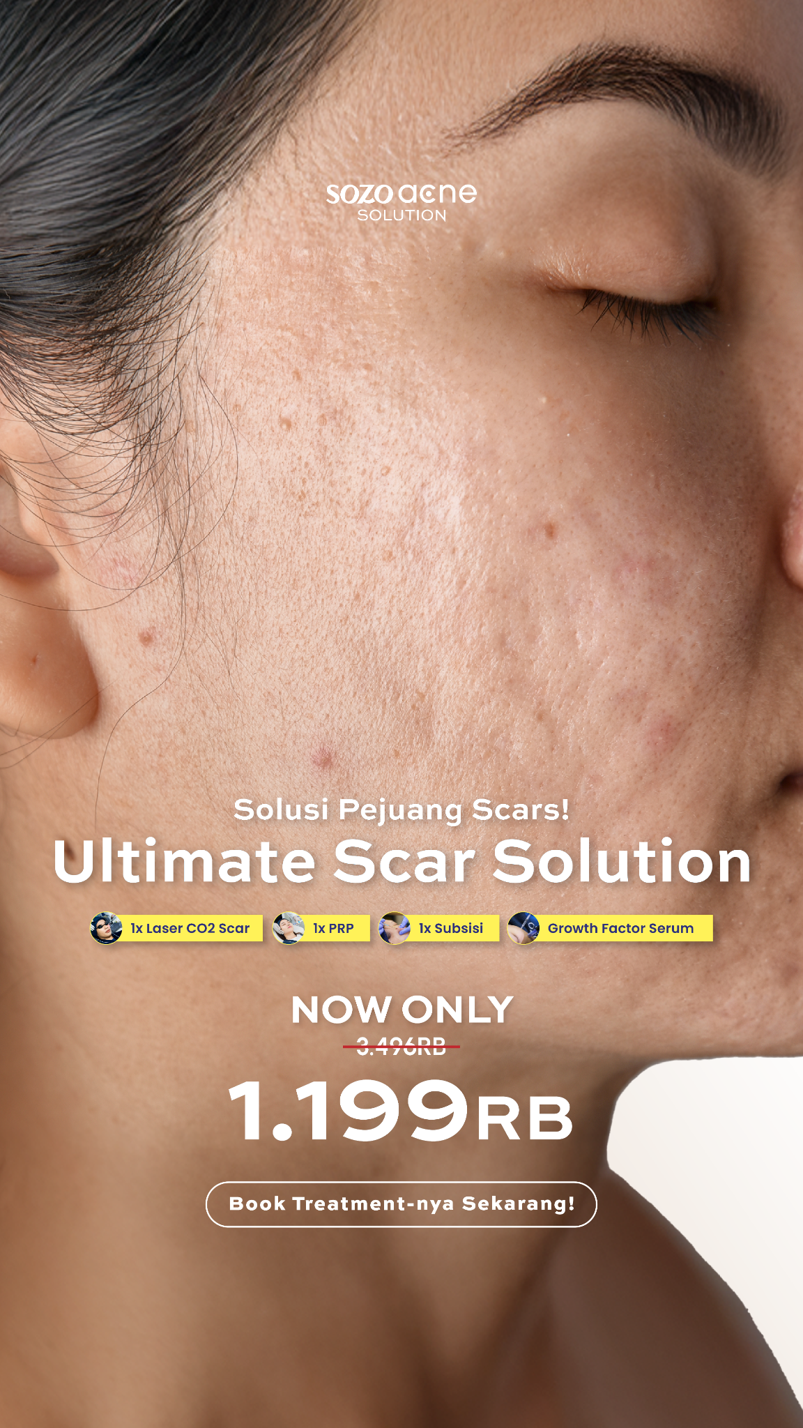 Sozo Acne Facebook ad