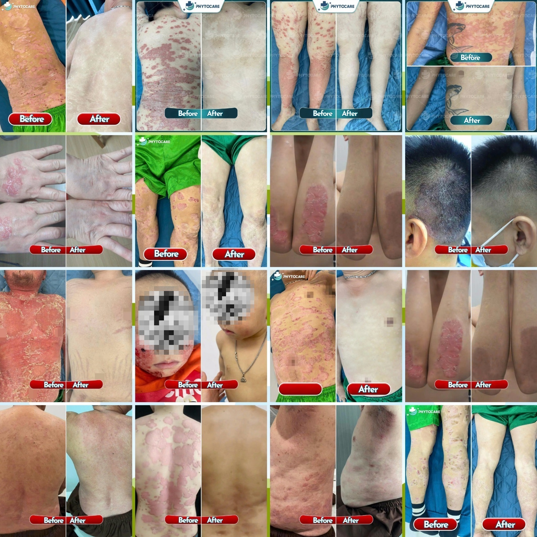 Phytocare Dermatology Clinic - Davao Facebook ad: Tired of dealing with flaky, itchy, red, and…