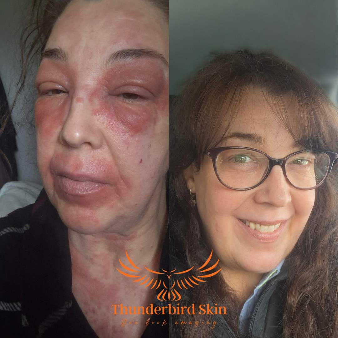 Thunderbird Natural Skincare - sensitive skin solutions Facebook ad