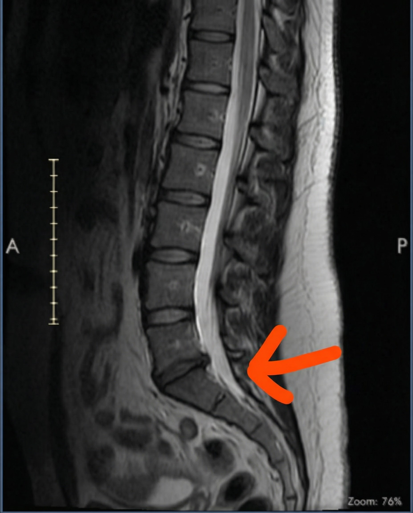 Spine Stories Facebook ad: My sciatica has been getting worse for weeks.