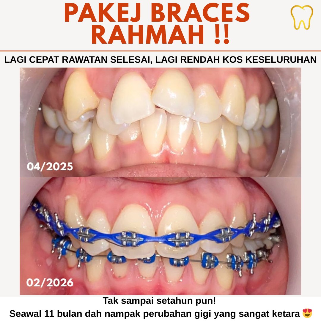 Klinik Pergigian Al-Huda Balok Implan dan Pembedahan Kecil Facebook ad: 𝗥𝗮𝗺𝗮𝗶 𝘁𝗮𝗻𝗴𝗴𝘂𝗵 𝗽𝗮𝗸𝗮𝗶 𝗯𝗿𝗮𝗰𝗲𝘀…