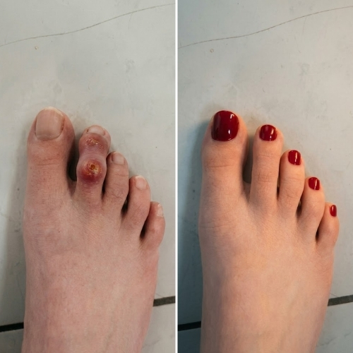 Linda Calloway Facebook ad: Read this if you suffer from hammertoes