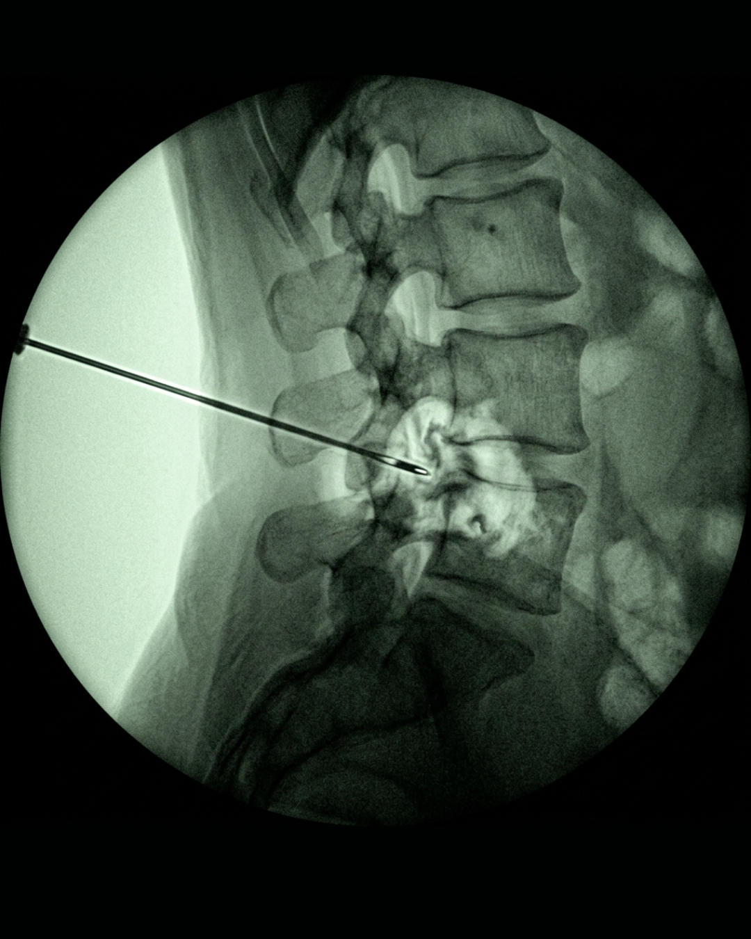 Emily Caldwell - Health After 50 Facebook ad: The most dangerous thing about sciatica isn't the pain.