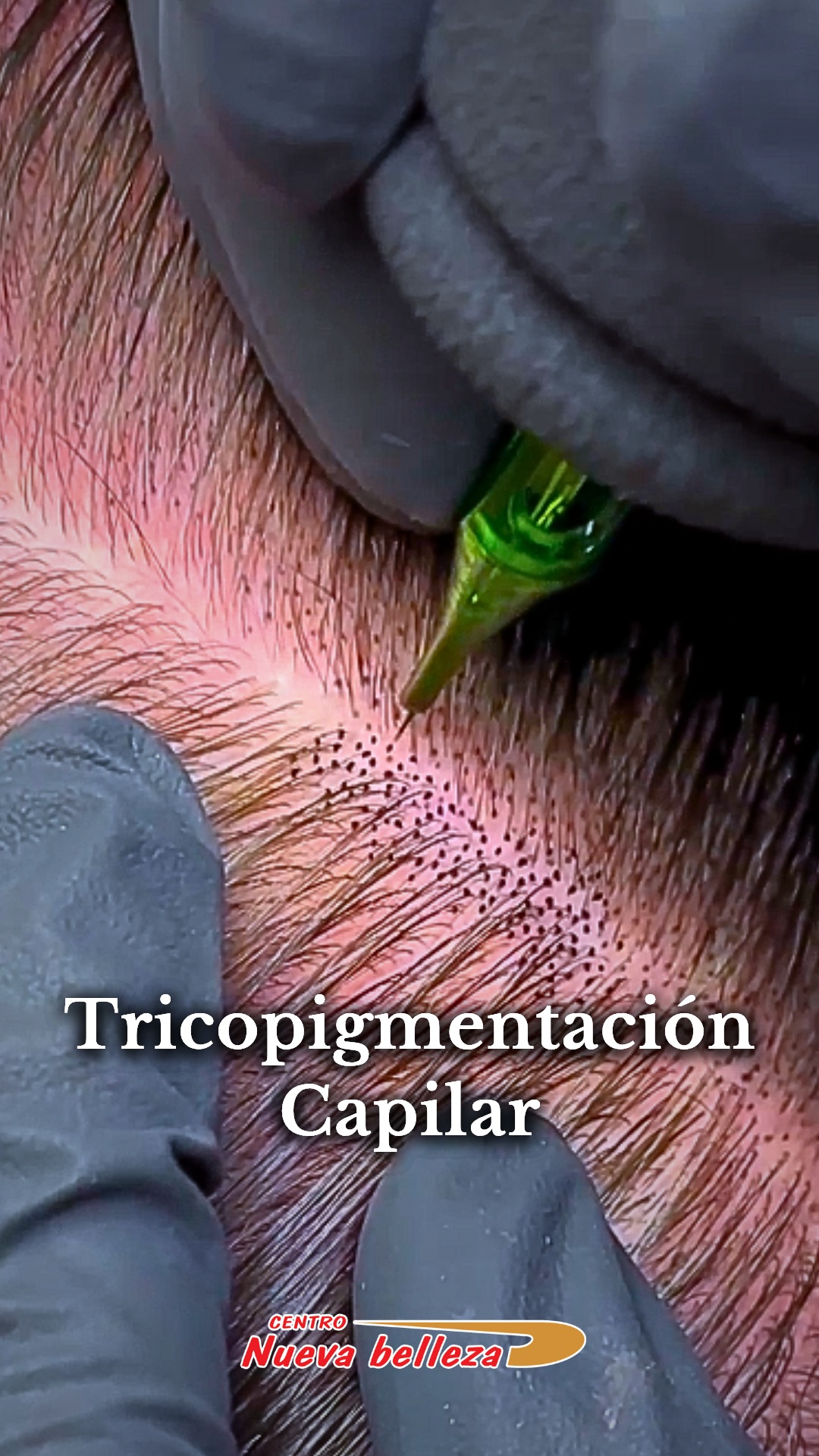 Centro Nueva Belleza Facebook ad: La Tricopigmentación Capilar es una técnica ideal para…