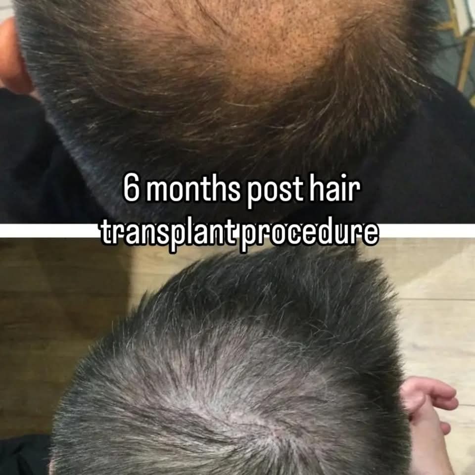 Tajmeel Clinic Facebook ad: Hair Transplant, hair loss treatment, Scalp…