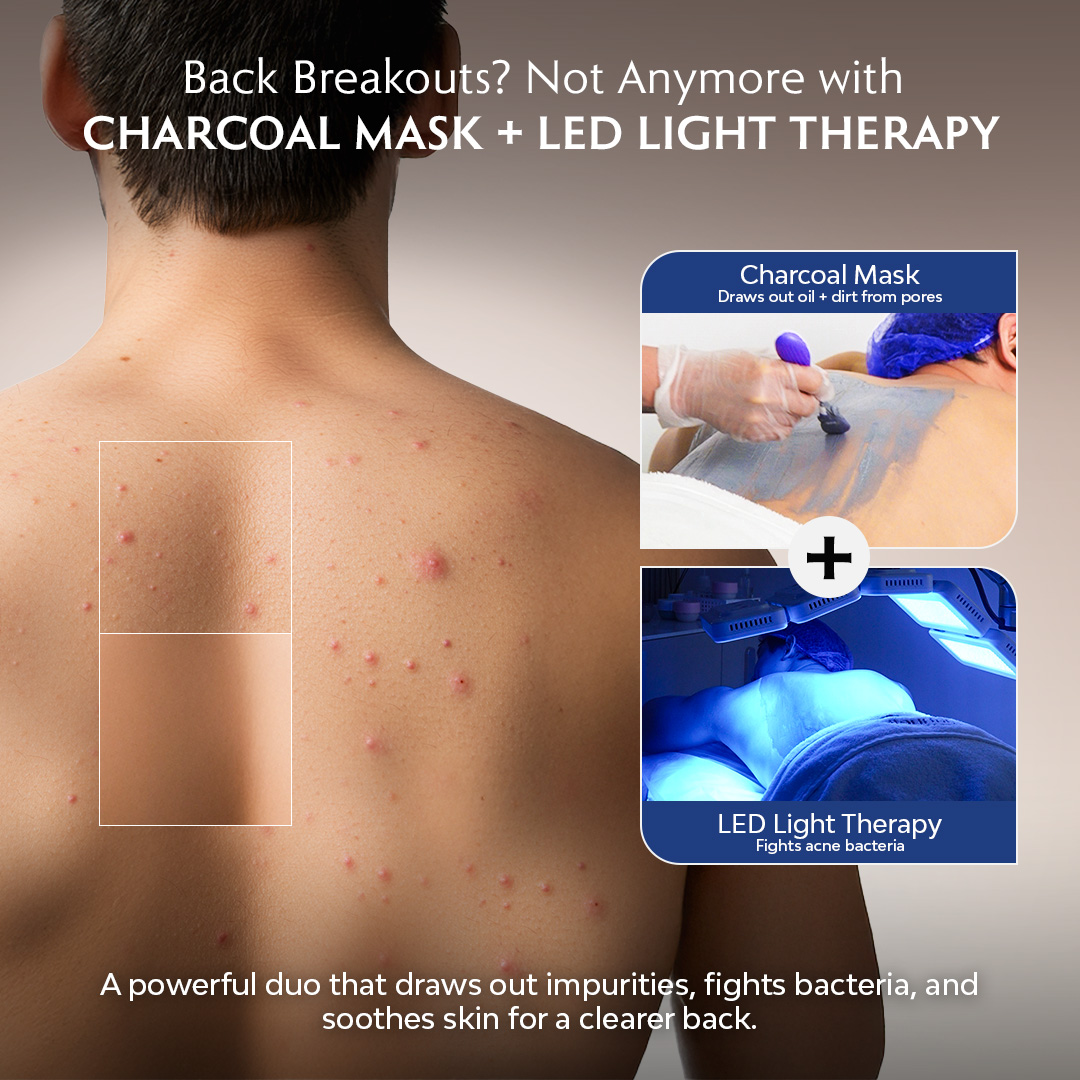 Venofye Aesthetics Cebu Facebook ad: ₱499 Clear Back Glow, Gentle Yet Powerful!