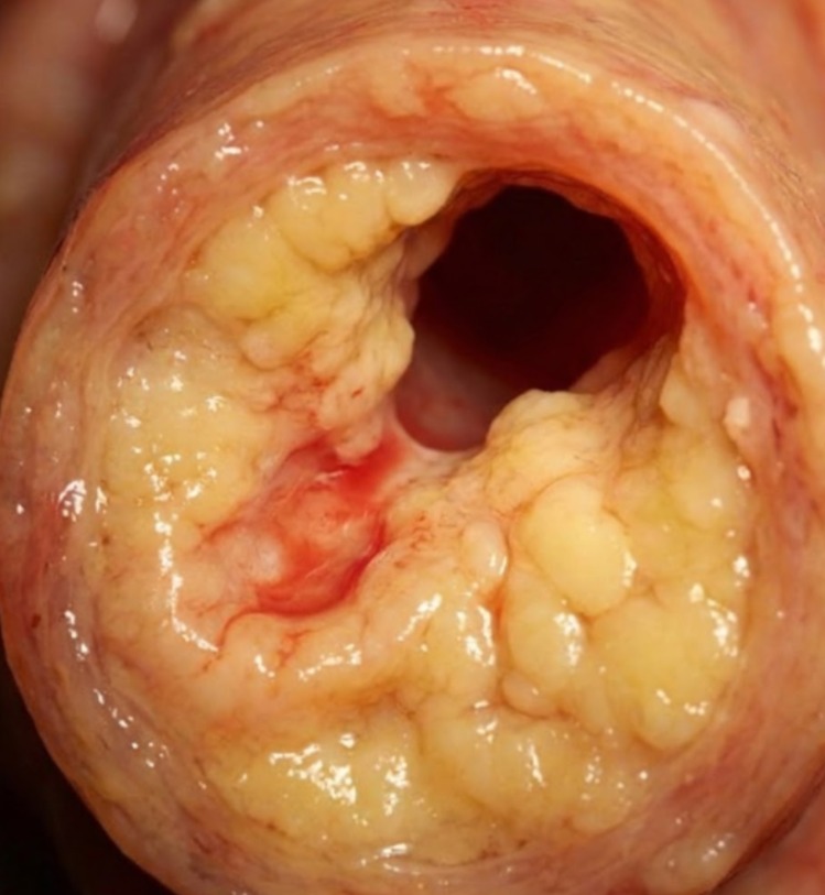The Cholesterol Circle. Facebook ad