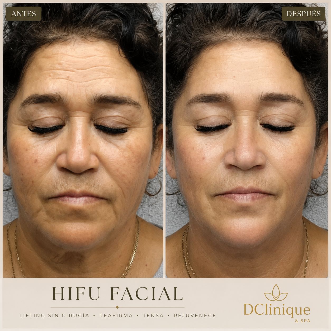 DClinique Facebook ad: HIFU LIFTING FACIAL SIN CIRUGÍA