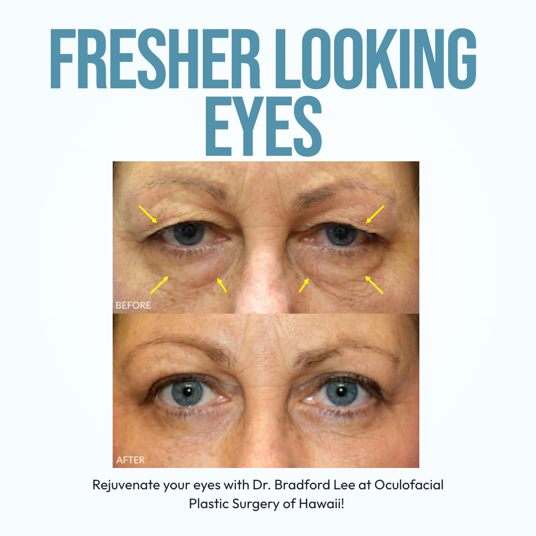 Oculofacial Plastic Surgery of Hawaii Facebook ad: Refreshed Eyes Honolulu