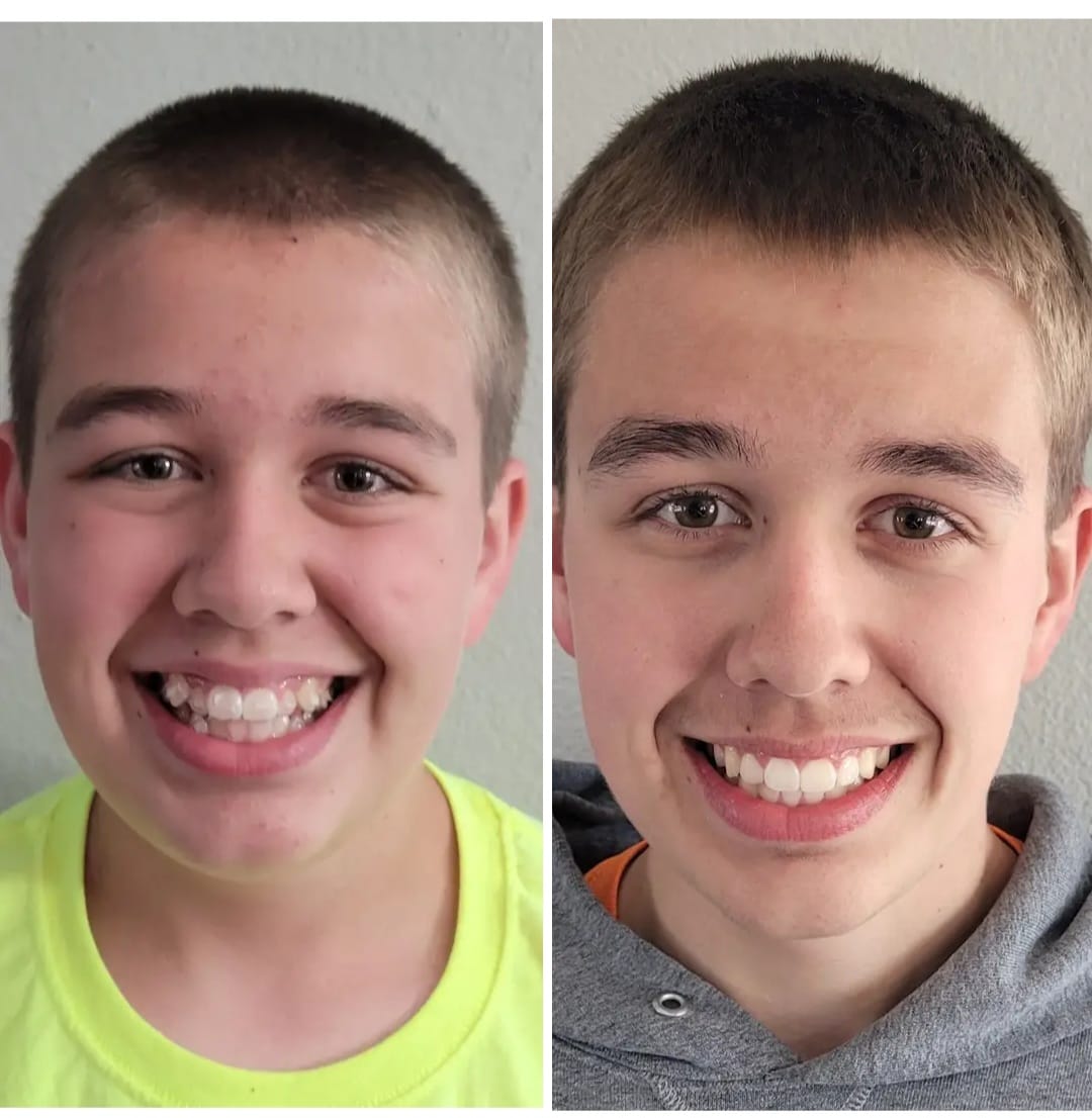 Invisalign Facebook ad