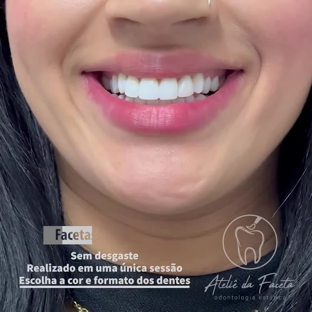 Ateliê da Faceta Facebook ad: Facetas em Resina