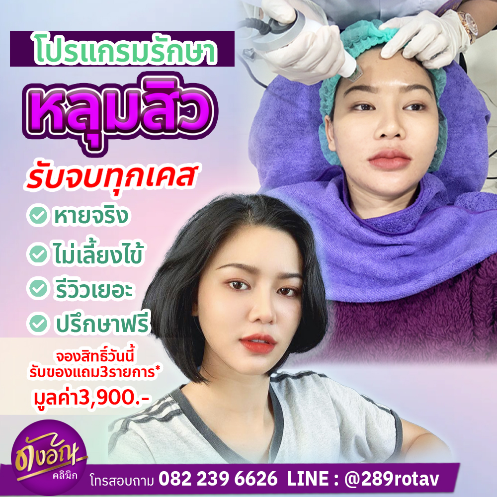 ดังอัณคลินิก สาขาตรัง Facebook ad: โปรแกรมสำหรับ หลุมสิว รอยสิว ลึก ตื้น กว้าง / แผลเป็น…