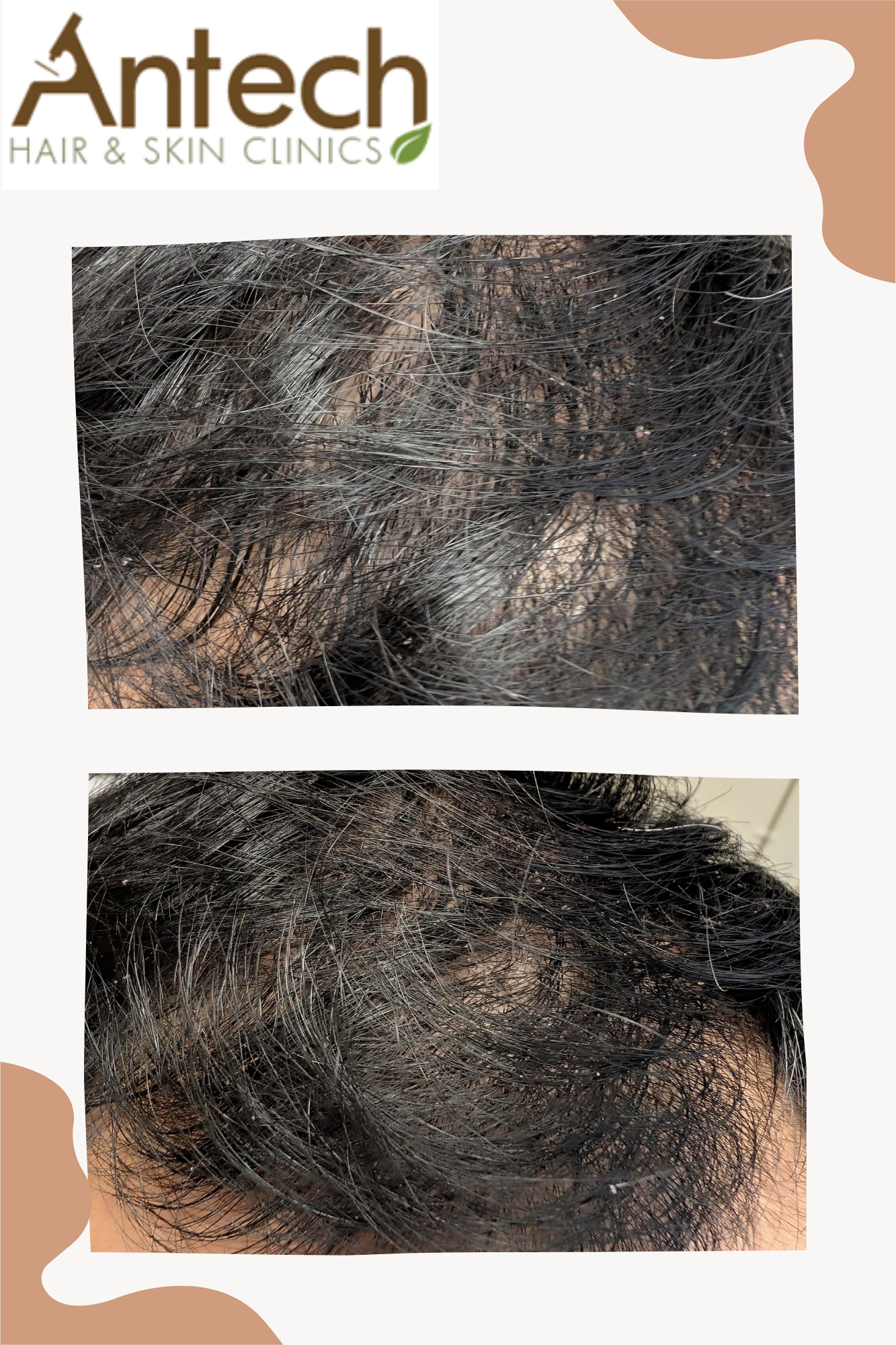 Antech Hair & Skin Clinic Facebook ad