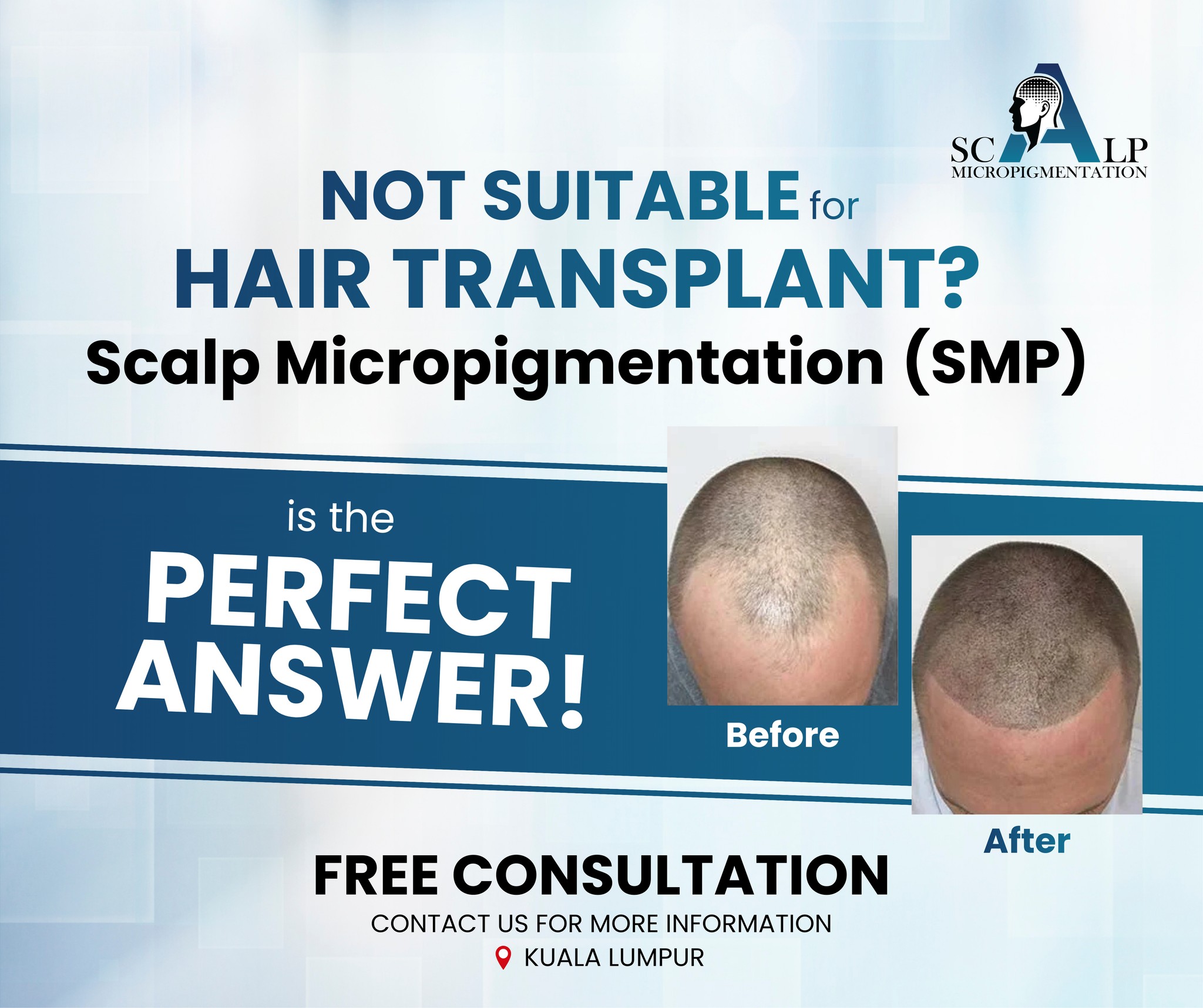 Advanced Scalp Micropigmentation Facebook ad: Not suitable for a hair transplant?