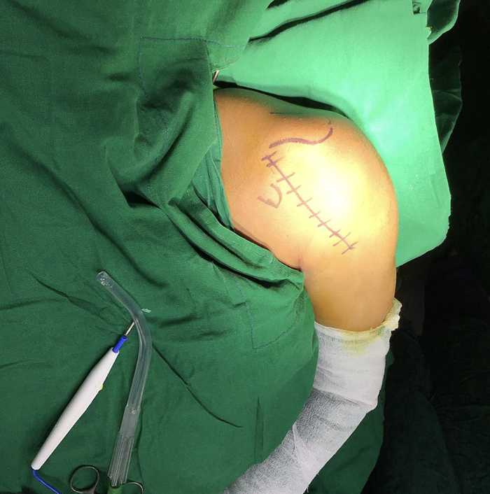 Jackson Miller Facebook ad: $25K SAVED ON SURGERY