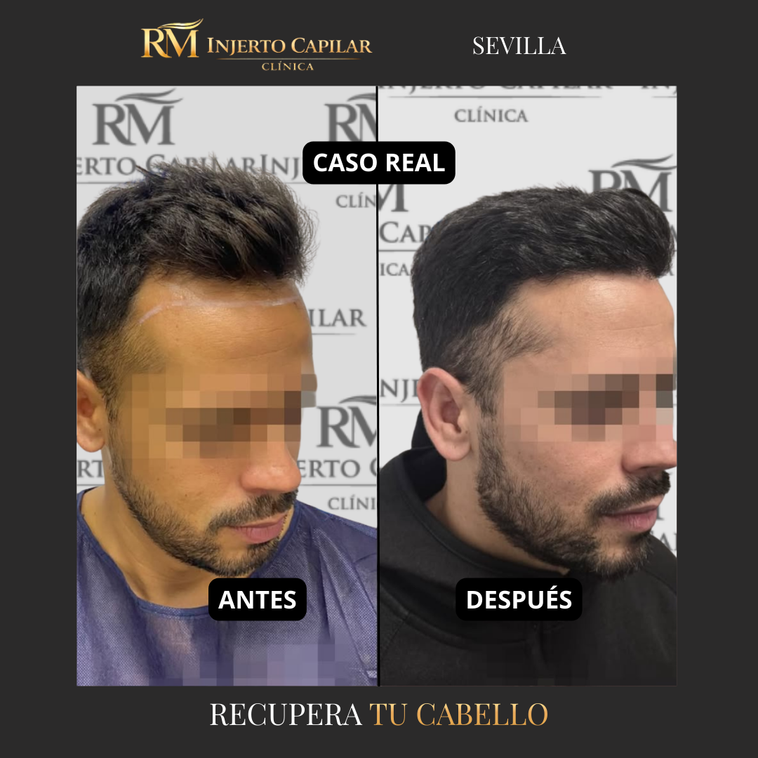 RM Injerto Capilar Facebook ad: Solicita tu valoración capilar gratuita