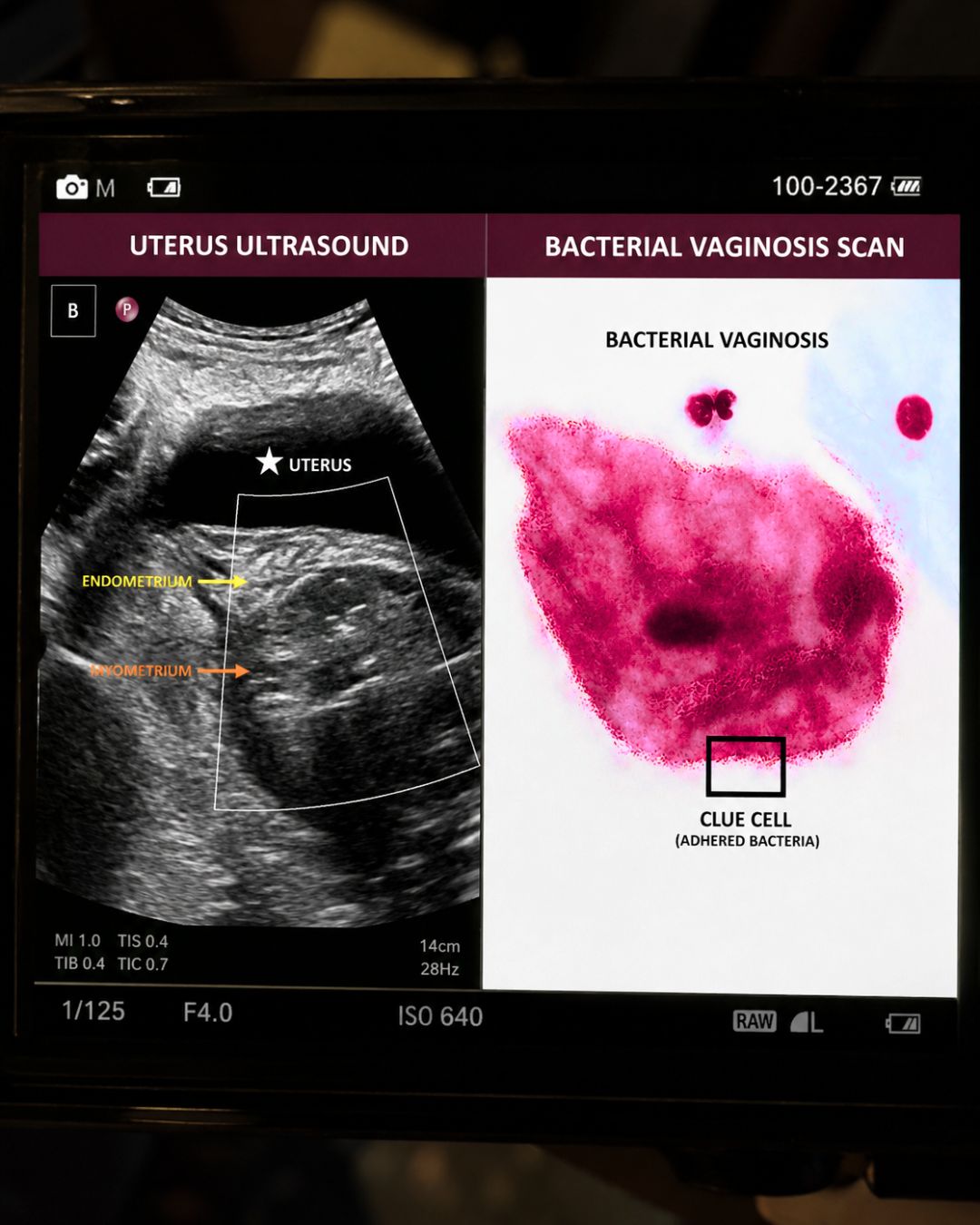 Patricia Lowe Facebook ad: Recurring BV? It Could Be Bacterial Dysbiosis