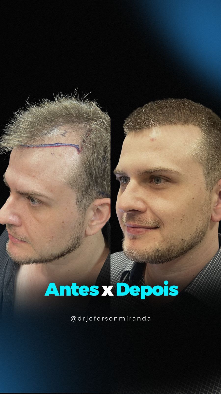 Dr. Jeferson Miranda Facebook ad: Precisão, técnica e resultados naturais.