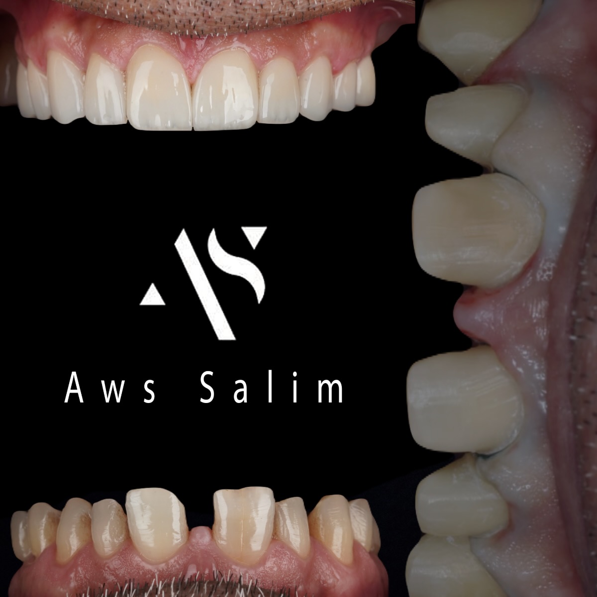 Dr. Awos Al Hamdanyدكتور اوس الحمداني:؛ Facebook ad: Smile makeover