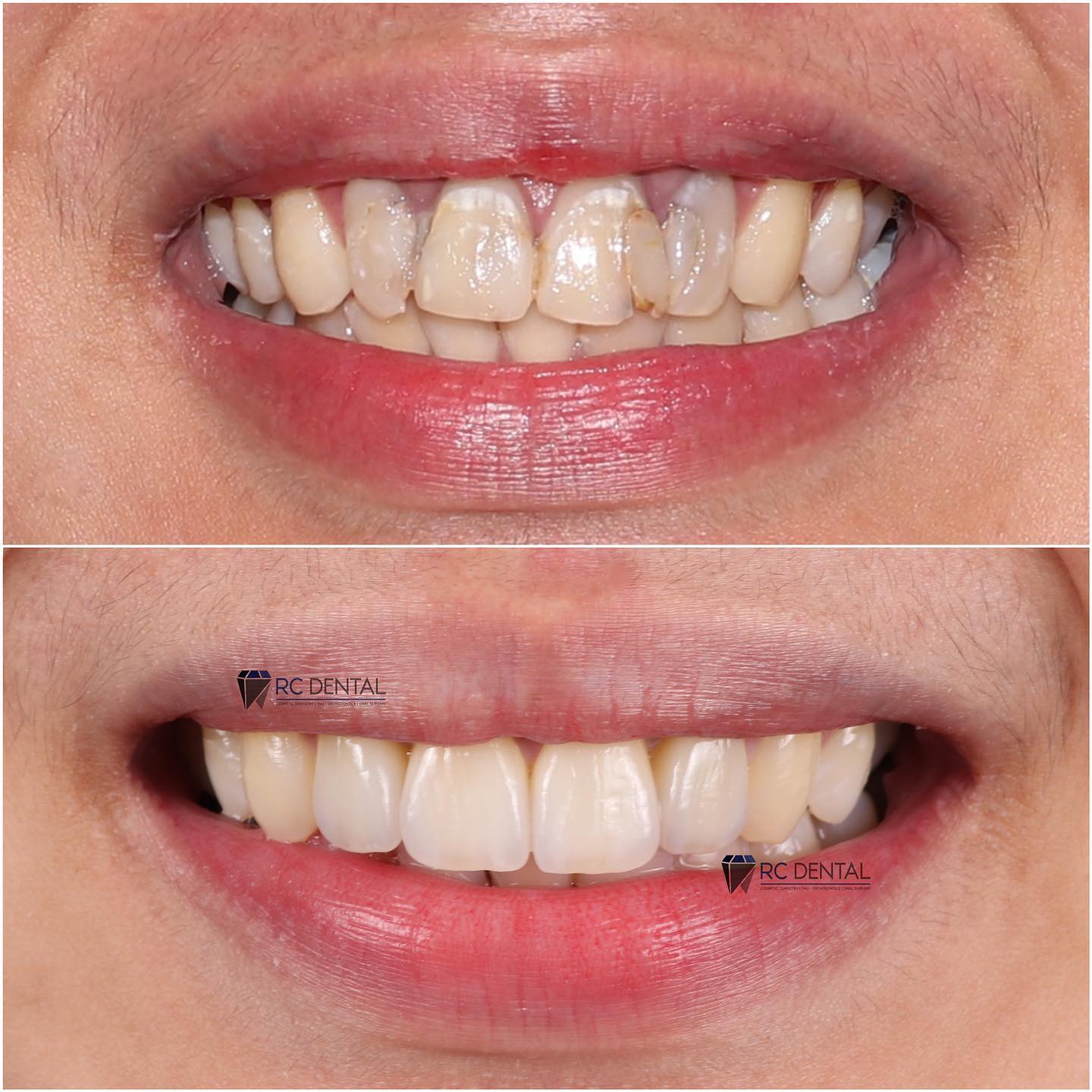 RC Dental Clinic Facebook ad: *Natural-looking* crowns and veneers by RC DENTAL