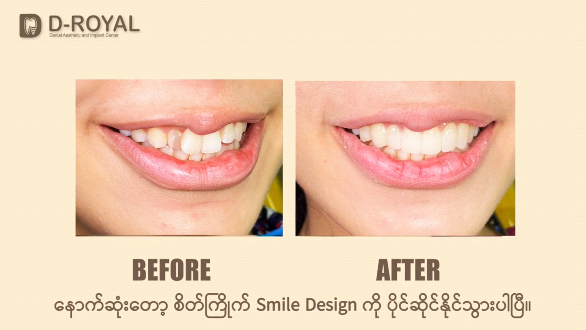 D-Royal Dental Aesthetic and Implant Center Facebook ad: သွားကြွေလွှာကပ်ခြင်း (Dental Veneers)