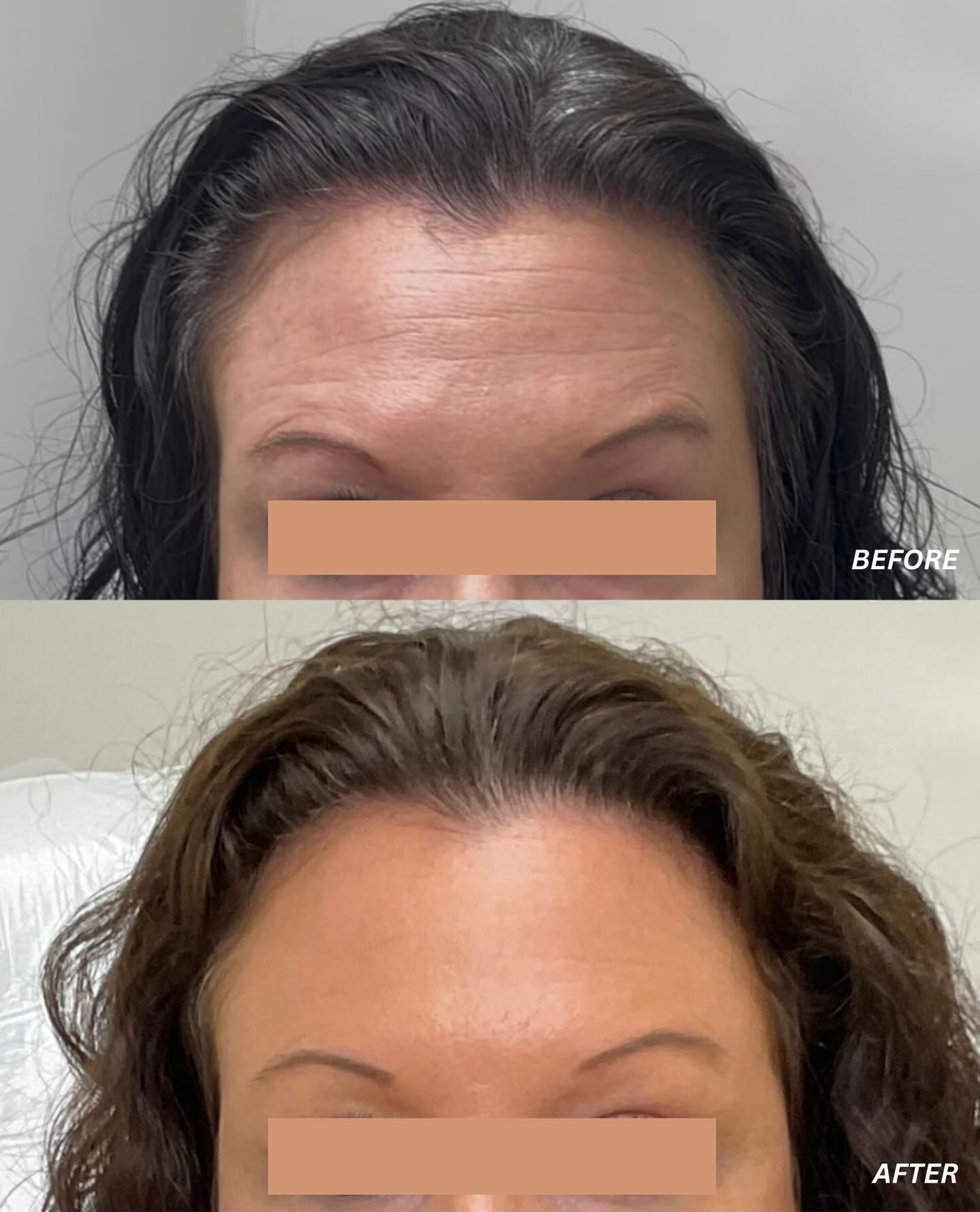 Luma Skin Clinics Facebook ad: Forehead transformation These lines were once static…