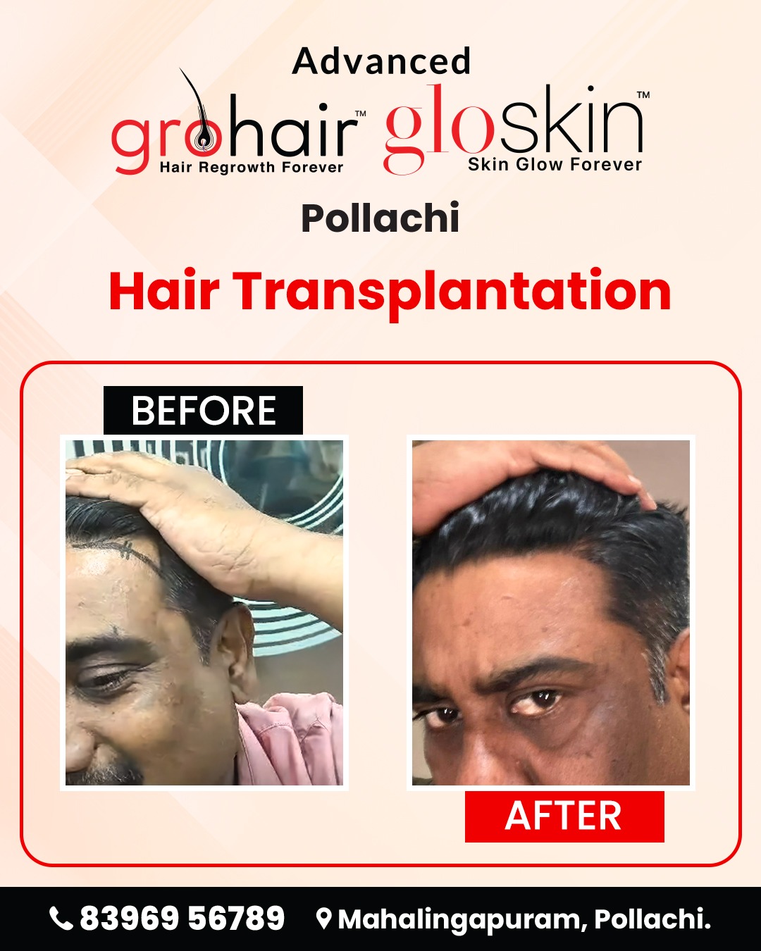 AdGrohairclinic Pollachi Facebook ad