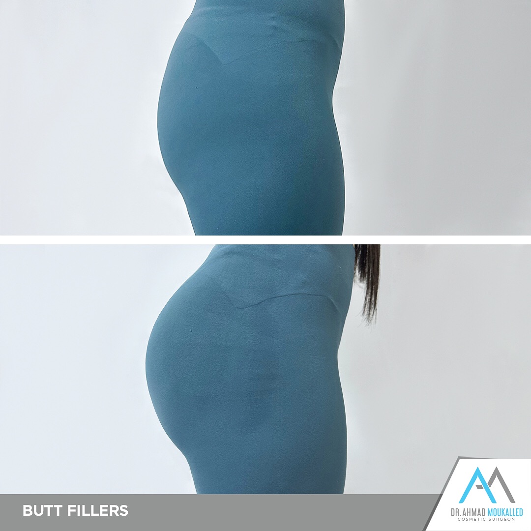 Dr. Ahmad Moukalled Facebook ad: Butt fillers power by the